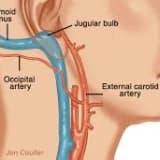 Tinnitus ve damarsal nedenler