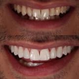Zirkonyum diş nedir ? Gülüş estetiği nasıl sağlanır ?