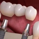 Dental İmplant Diş Tedavisinin Avantajları Nelerdir ?