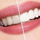 Diş Beyazlatma / Bleaching İşlemi