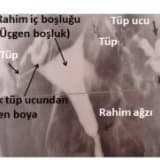 HSG (Histero-Salpingo-Grafi):
