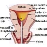 Histeroskopi nedir? Hangi konularda kullanabiliriz?