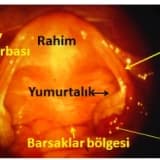 Laparoskopi nedir ? Hangi operasyonlar başarı ile yapılabilir?