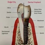 Eksik diş ve diişlerin yerine implant
