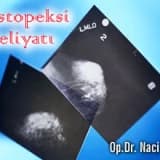 Mastopeksi ameliyatında karşılaşabileceğiniz problemler