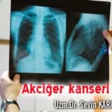 Akciğer kanserinde erken korunma tanı ve tadavi yöntemleri