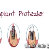 İmplant Protezler