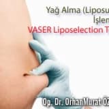 Yağ alma (liposuction) işleminde vaser liposelection tekniği