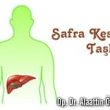 Safra kesesi taşları