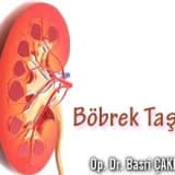 Böbrek taşları, belirtileri ve tedavisi