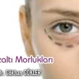 Gözaltı morlukları!
