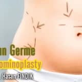 Karın Germe Abdominoplasty