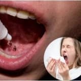 Çocukluk Çağında Astımda Alerji Aşı Tedavisi ( İmmünoterapi )