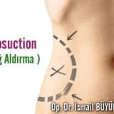 Liposuction ( Yağ Aldırma )