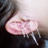 ŞİŞMANLIĞIN NEDENLERİ VE AKUPUNKTUR İLE ZAYIFLAMA