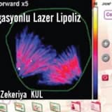 Navigasyonlu lazer lipoliz; lipocontrol