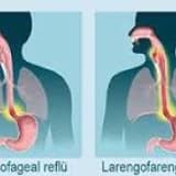 Gastroözefageal Reflu-Larengofarengeal Reflü Hastalığı- Mide Asidinin Boğaza ve Ağıza Gelmesi-Mide Asidi Regürjitasyonu