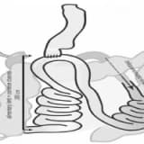 Obezite ve metabolizma cerrahisinde yeni ve umut vaadeden teknik: proksimal duodenal ileal end-to-side bypass + sleeve gastrektomi