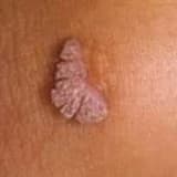 HPV,genital siğiller ve rahim ağzı kanseri