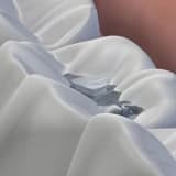 Amalgam dolgular