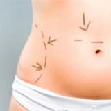 Liposculpture, estetik cerrahinin insan bedenine sanatsal dokunuşudur