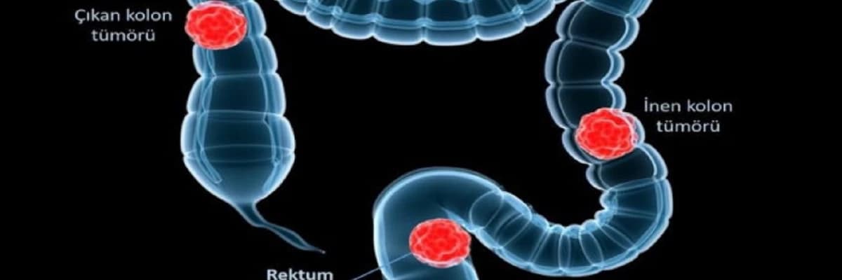 Takipte Kalın! Kolon Kanserini Önlemek İçin Yapabileceğiniz En İyi Şey.