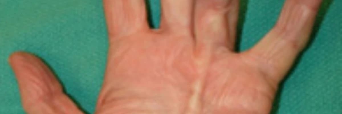 Dupuytren Hastalığı