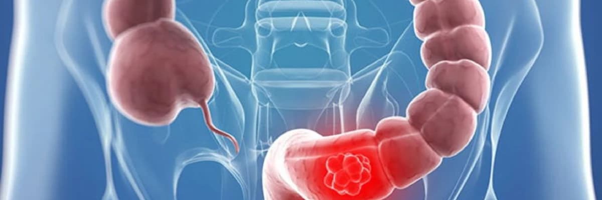 Kolon kanseri ve tarama yöntemleri