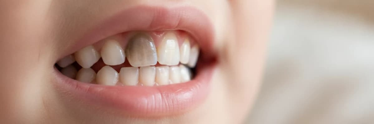 Çocuklarda Diş Renklenmesi: Tek Diş Renk Değişimi Ne Anlama Gelir?