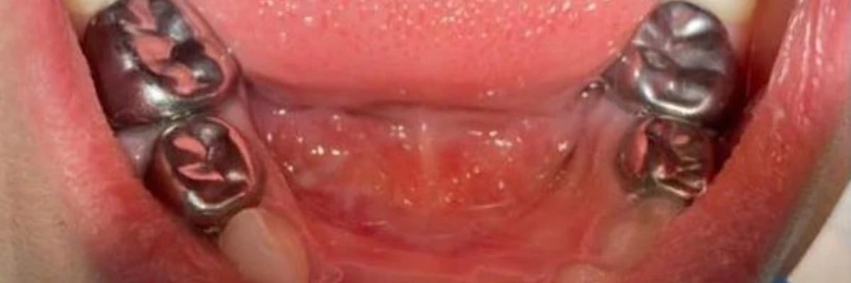 Pediatrik Prefabrik Kron Nedir?