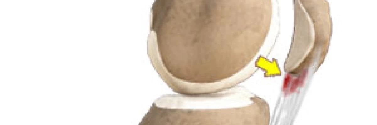 Patellar Tendinit ve Ön Diz Ağrısı