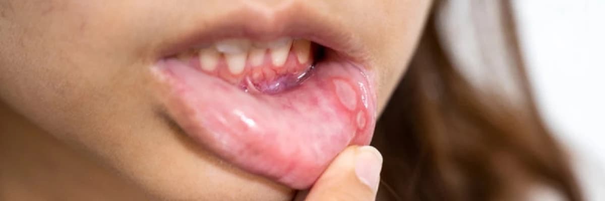 Aft nasıl geçer, afta ne iyi gelir? Aft neden olur? 8 soruda aftla ilgili merak edilenler