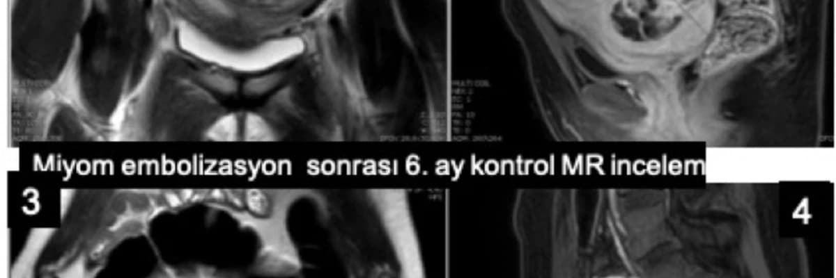 MİYOMEKTOMİ SONRASI MİYOM EMBOLİZASYONU YAPILIR MI?