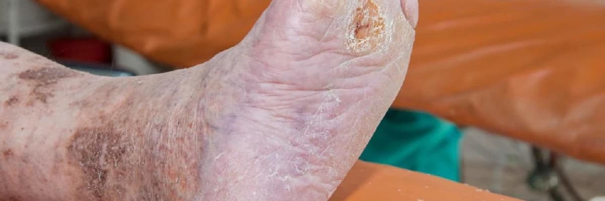 Diyabetik Ayak Ülseri Neden Oluşur? Erken Belirtiler ve Tedavi Süreci