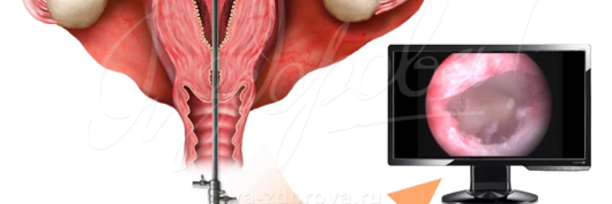 Tüp bebekte gebeliği arttıran ilginç bir yöntem: histeroskopik endometrial hasarlama
