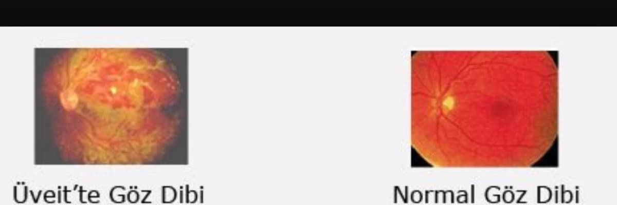 Üveit nedir? Tedavisi nasıldır?