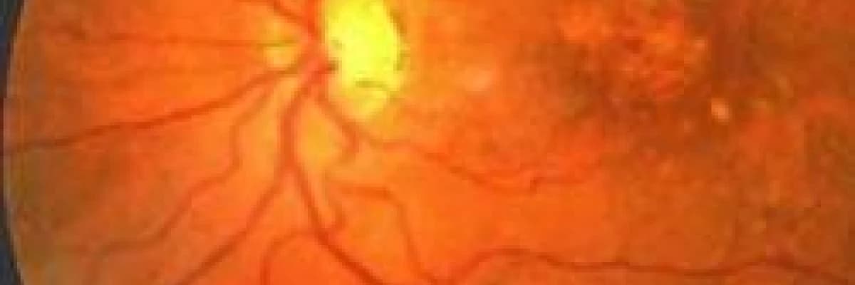 Sarı  nokta  hastalığı