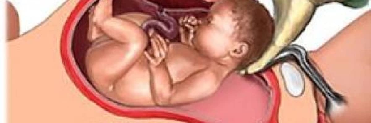 Sezeryan (Sezaryen)!!