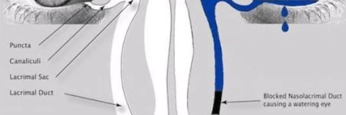 WHAT IS A BLOCKED TEAR DUCT ?