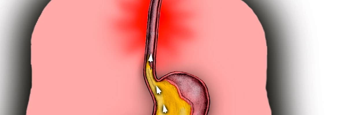 Gastroözofageal Reflü Hastalığında Beslenme