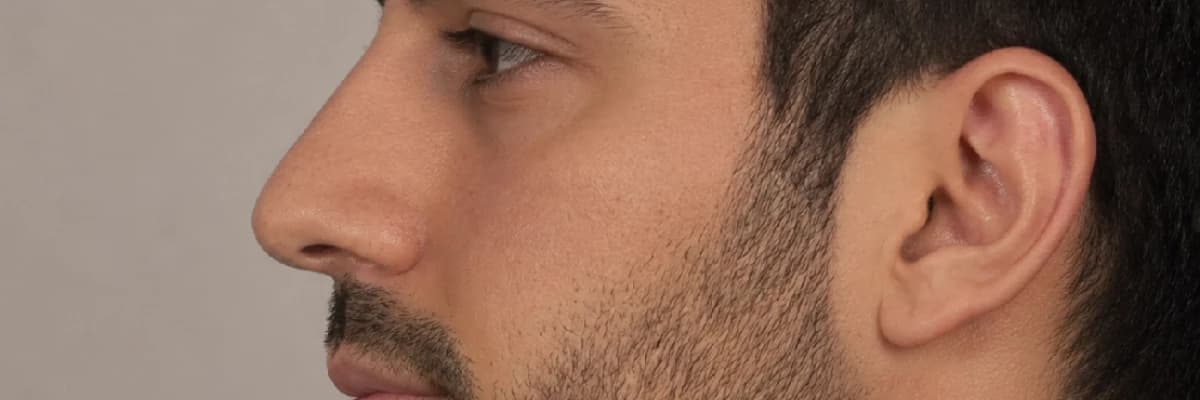 Erkek Rinoplastisinde Cerrahi Perspektifim: Maskülen Hatları Korurken Yapısal Bütünlüğü Sağlamak