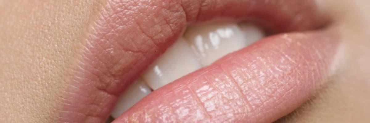 Dudak Dolgusu ile Dolgun Dudaklar