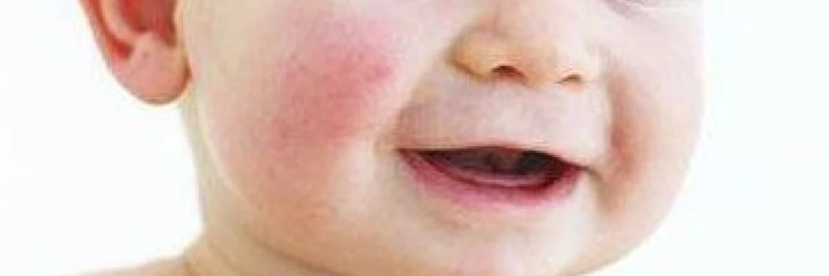 Atopik Dermatit - Çocukluk Çağı Ekzeması