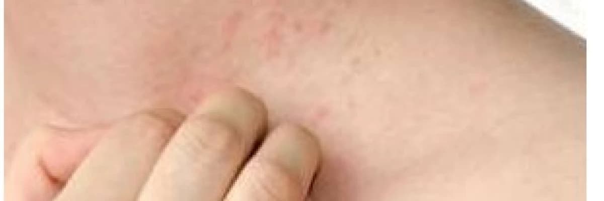 ÜRTİKER (KURDEŞEN) TANI VE TEDAVİ SÜRECİ