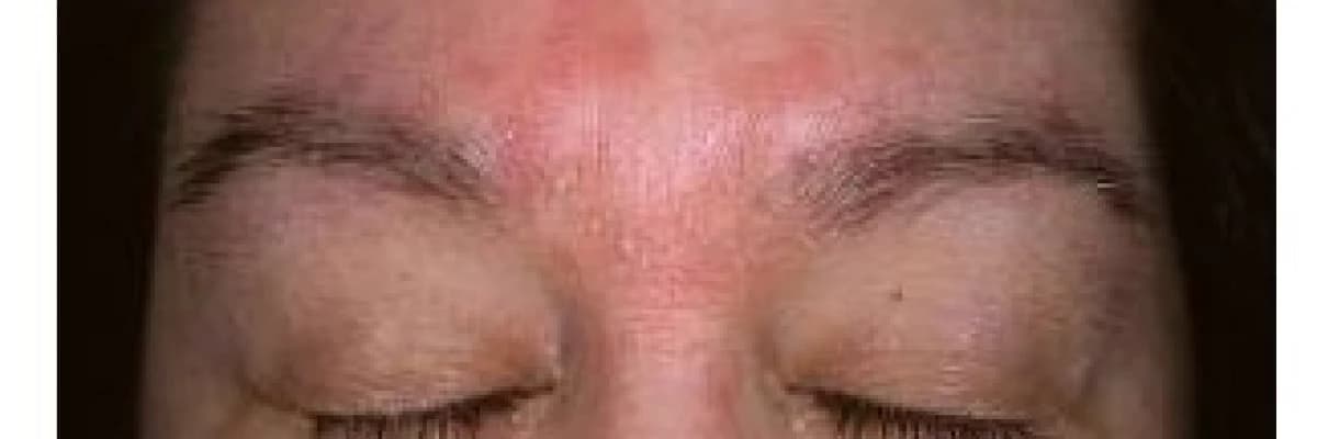 Sık görülen bir deri hastalığı: Seboreik Dermatit!
