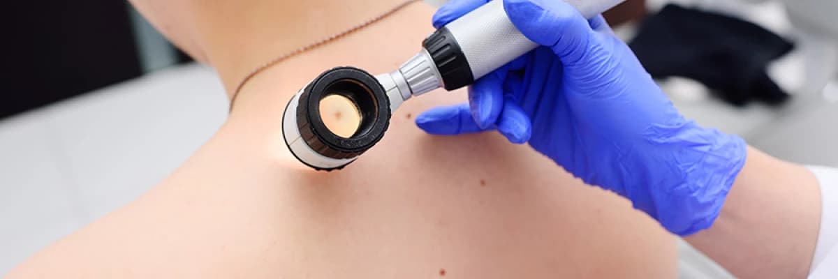 MELANOM RİSK TESTİ