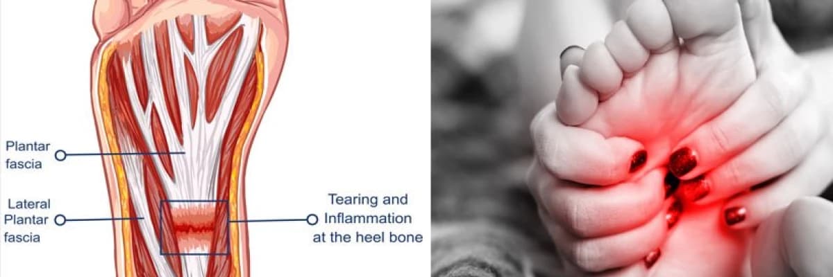 topuk dikeni ve ayak ağrısında güncel tedaviler