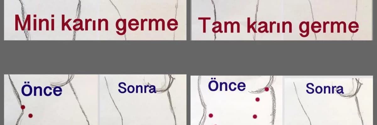 Karın Germe Operasyonu Hakkında Sık Sorulan Sorular