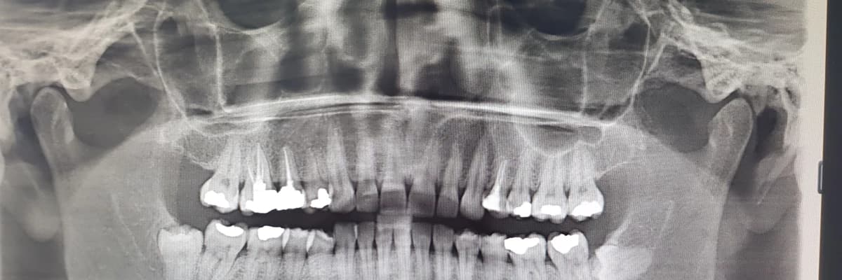 20 yaş dişleri her zaman çekilmeli midir?