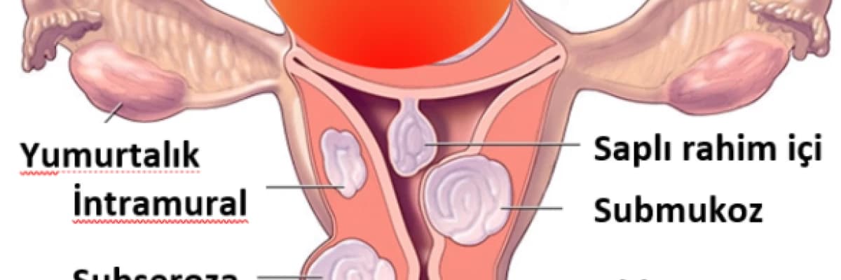 Myom(Fibrom)